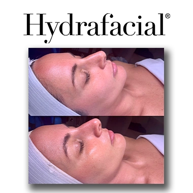 Hydrafacial at Estrela Skincare